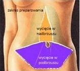 zabieg-pelnej-abdominoplastyki2a
